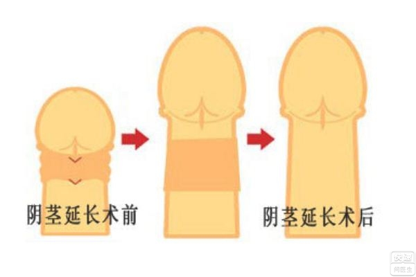 道县较好男科医院小阴茎怎么保证性生活质量?
